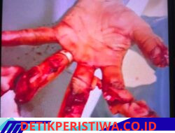 Cedera Akibat Mesin, Legalitas dan Keselamatan Pekerja di Bekasi Dipertanyakan
